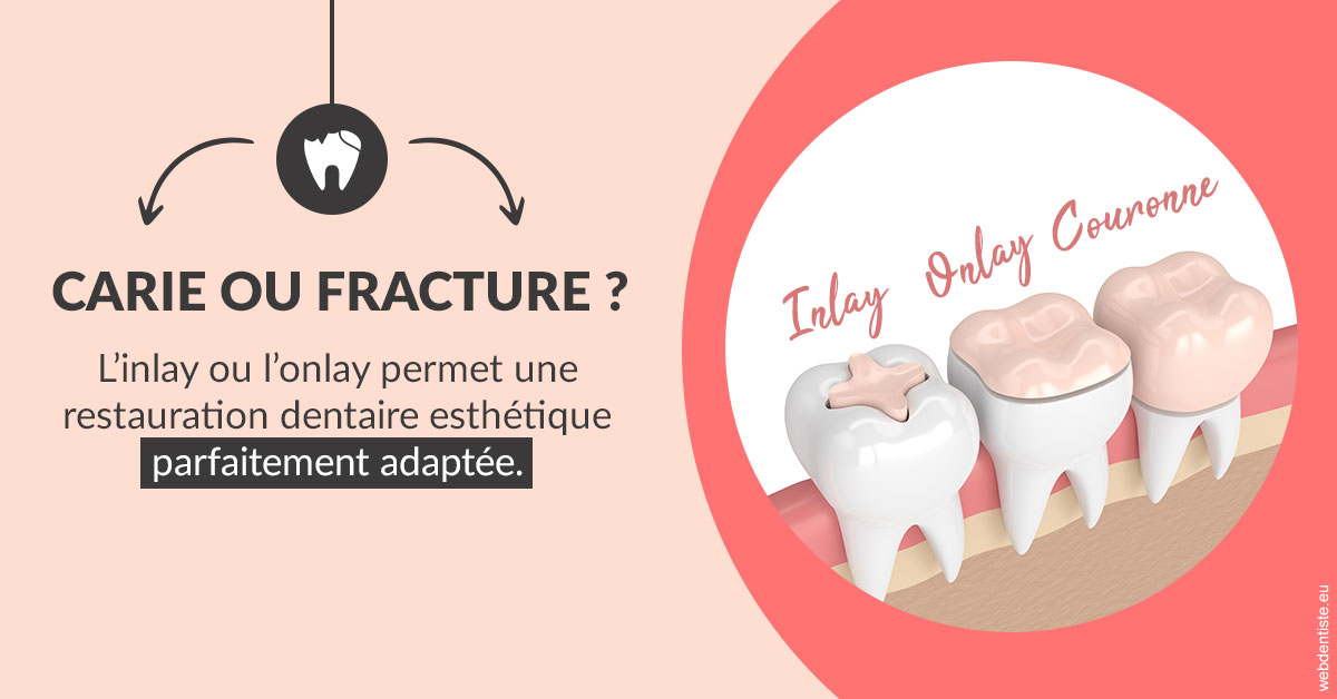 https://dr-estrabol-nicolas.chirurgiens-dentistes.fr/T2 2023 - Carie ou fracture 2
