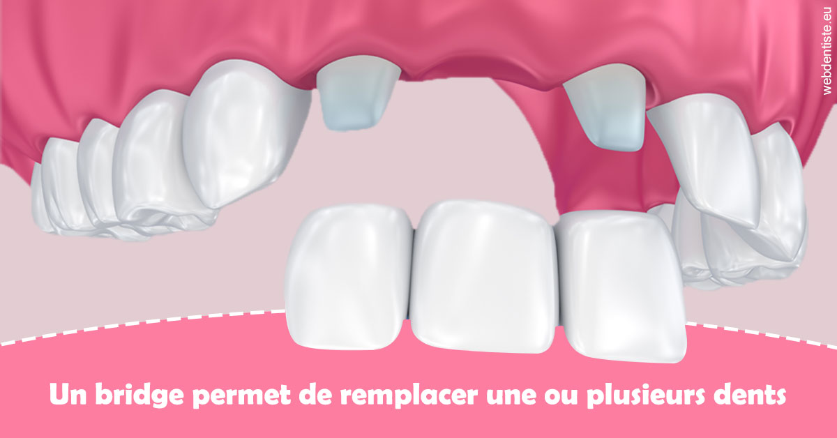 https://dr-estrabol-nicolas.chirurgiens-dentistes.fr/Bridge remplacer dents 2