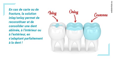 https://dr-estrabol-nicolas.chirurgiens-dentistes.fr/L'INLAY ou l'ONLAY