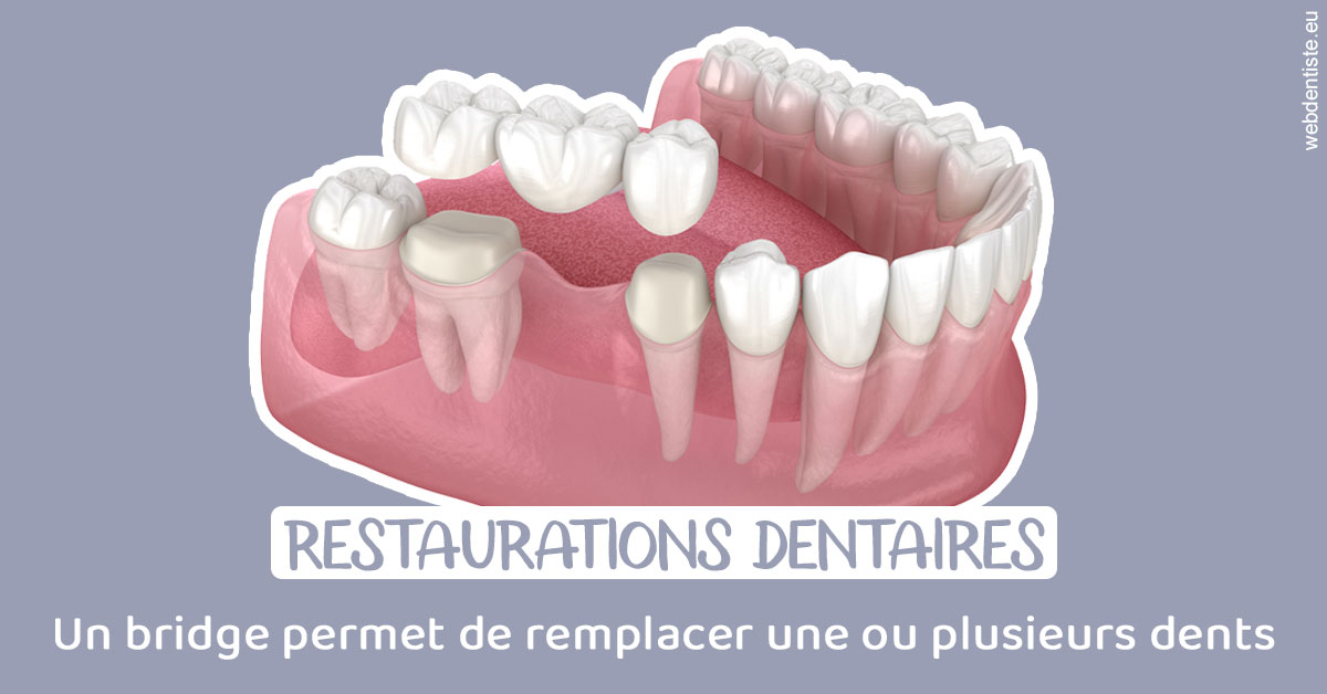 https://dr-estrabol-nicolas.chirurgiens-dentistes.fr/Bridge remplacer dents 1