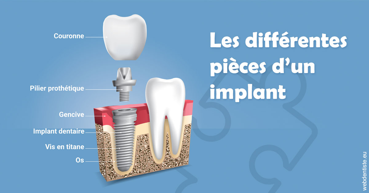 https://dr-estrabol-nicolas.chirurgiens-dentistes.fr/Les différentes pièces d’un implant 1